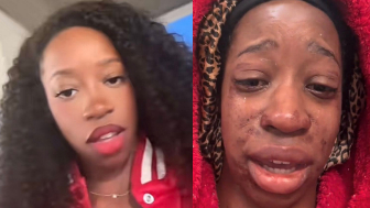 Woman says MAGA supporters left chemical burns on her face with bear spray, BUT ...