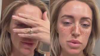 Liberal women are now getting freckles tattooed on their faces