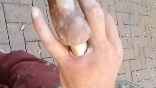 Man has Severe Infection after his Wedding Ring got Stuck