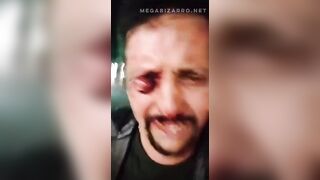 Man begs for Help after his Eye was Gouged and Dangling