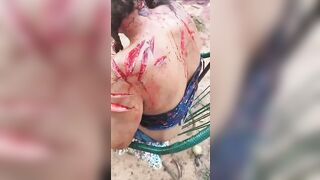 Woman Suffering after being Chopped up with Machete Barely Alive
