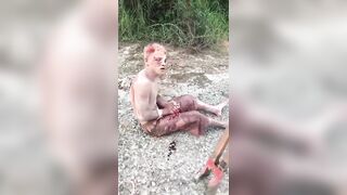 Man loses All Fingers on Right hand from a Post Hole Digger