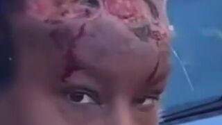 Sad Video: Girl who Once had a Life has Infected Skull and Forehead from Drug injections