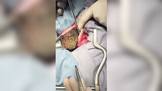 Uzbekistan..Girl is Brought in with Stomach Pain and they Pull out...