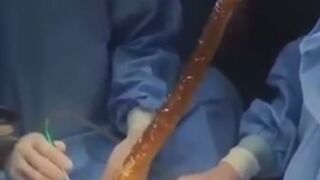 Doctors Remove 3 Foot Long Dildo from Man's Intestines..He said he "Accidentally" Fell On It.