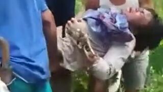 Woman in PAIN after Burning her Arm ALL the Way Down to the Bone