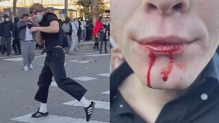 Strasbourg Protest: Police Flash-Ball Round Strikes Protester in Jaw