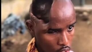 Somali Man Lost Half His Brain But Is Somehow Still Alive