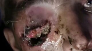 Soldier on the Front with Eye Injury could not get Medic Help for a While