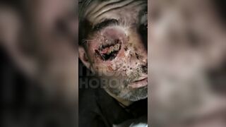 Soldier on the Front with Eye Injury could not get Medic Help for a While