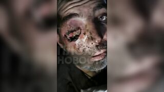 Soldier on the Front with Eye Injury could not get Medic Help for a While