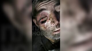 Soldier on the Front with Eye Injury could not get Medic Help for a While