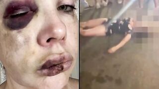 Ohio Senator Releases Horrific Photos Of The White Woman Beaten by Blacks