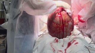 Incredible sized Tumor removed from 19 Year Old Girl (Successfully)