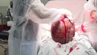 Incredible sized Tumor removed from 19 Year Old Girl (Successfully)