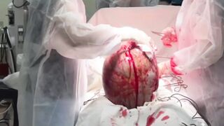 Incredible sized Tumor removed from 19 Year Old Girl (Successfully)
