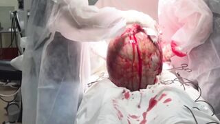Incredible sized Tumor removed from 19 Year Old Girl (Successfully)